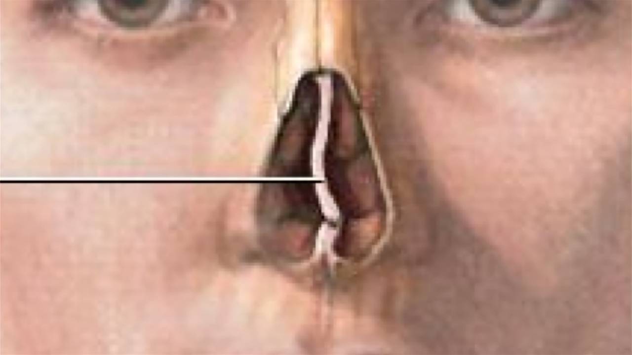 Cirurgia do desvio de septo - septoplastia